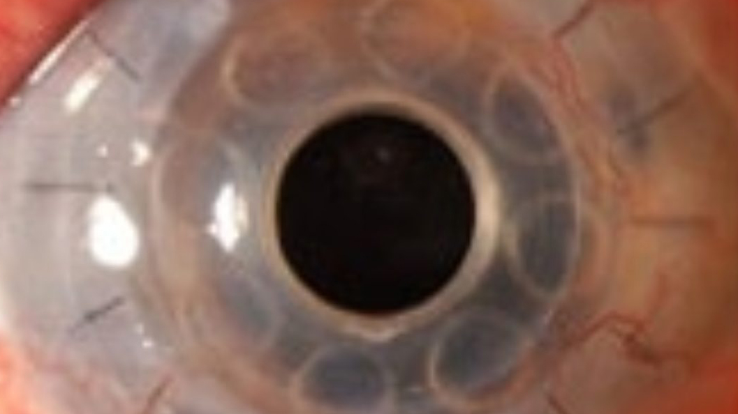 Cornea artificiale