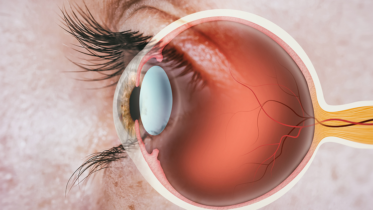 Il distacco di retina
