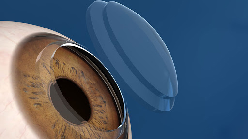Trapianto di cornea