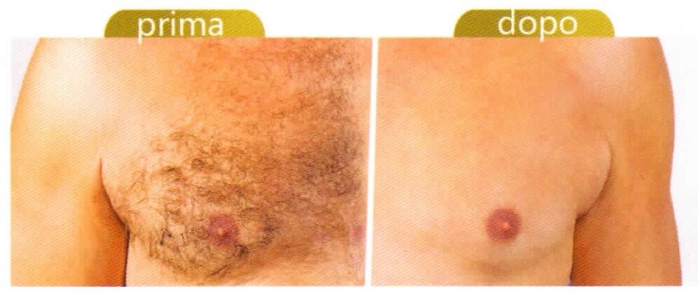 Laser terapia