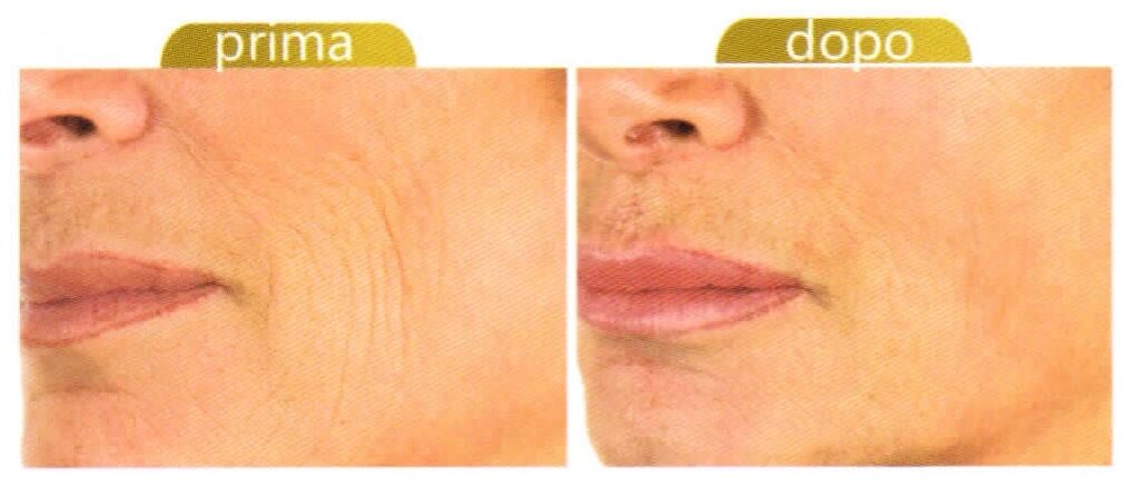 Mesoterapia per il viso